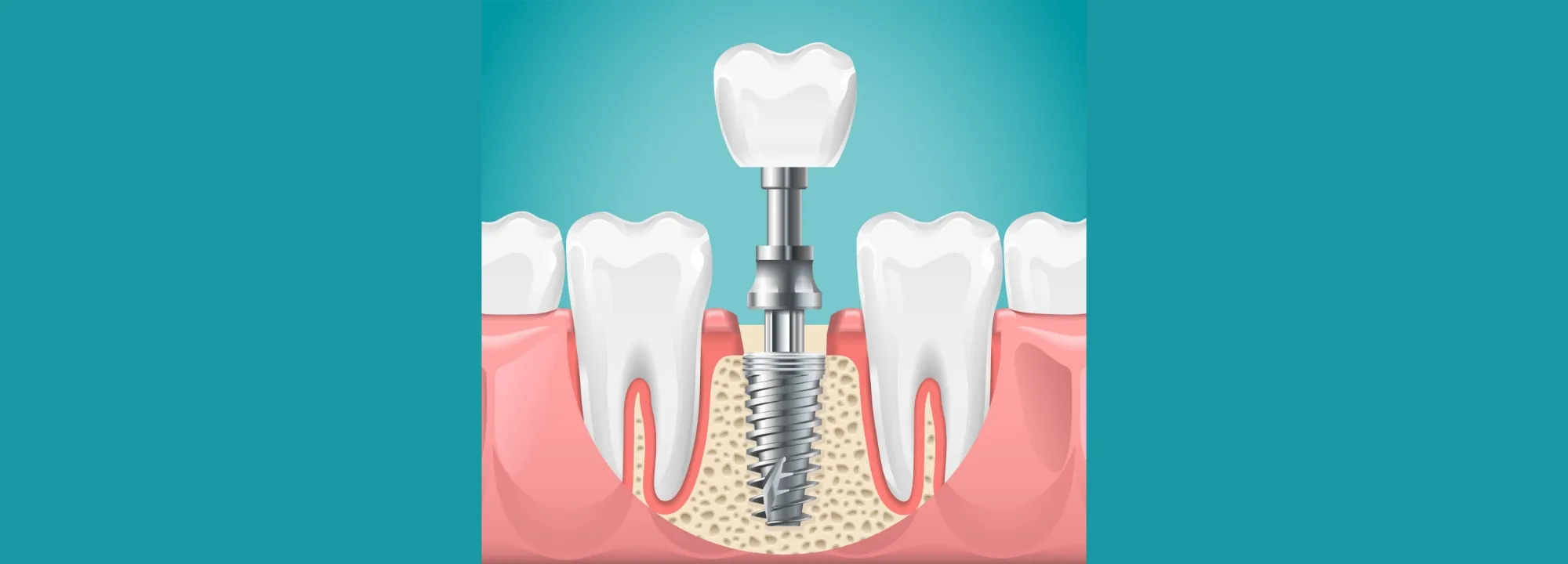 インプラントとは