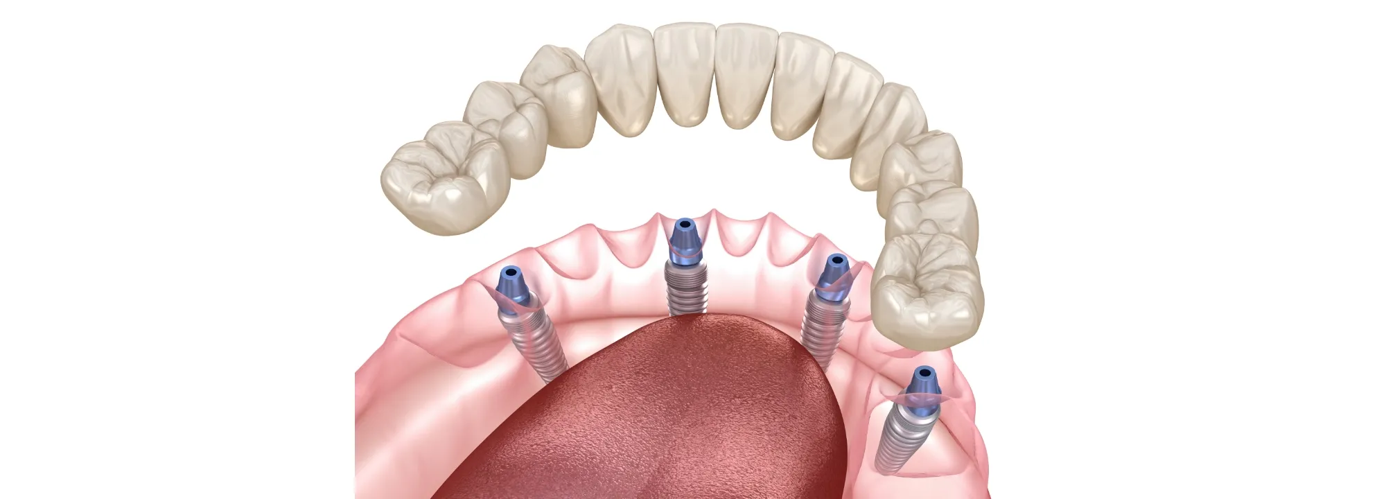 1日で噛めるインプラント治療